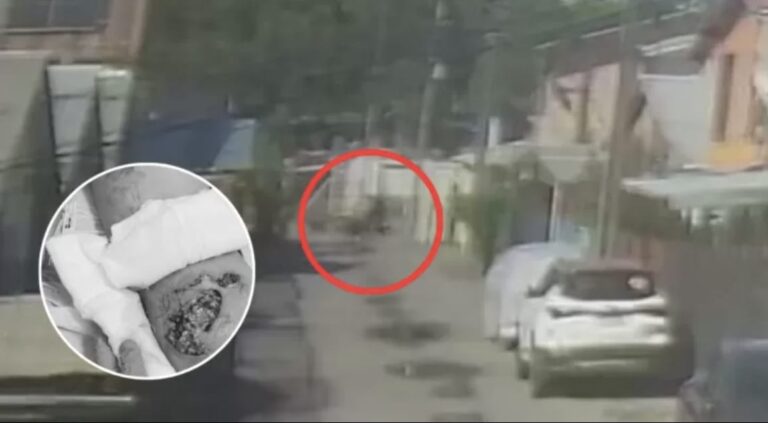 Joven fue ATACADA brutalmente por PERROS en San Pedro de la Paz: Debió recibir INJERTOS